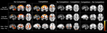 A Functional Magnetic Resonance Imaging Investigation of Hot and Cool Executive Functions in Reward and Competition.